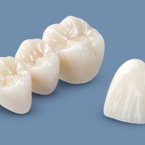 Bridges-and-Veneers-in-Preston